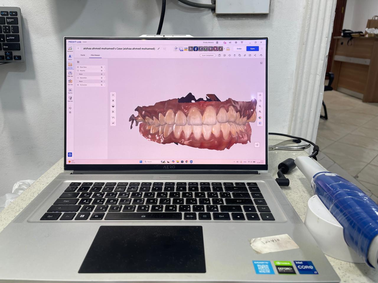 3D digital scan of a patient's teeth displayed on screen, captured with an intraoral scanner